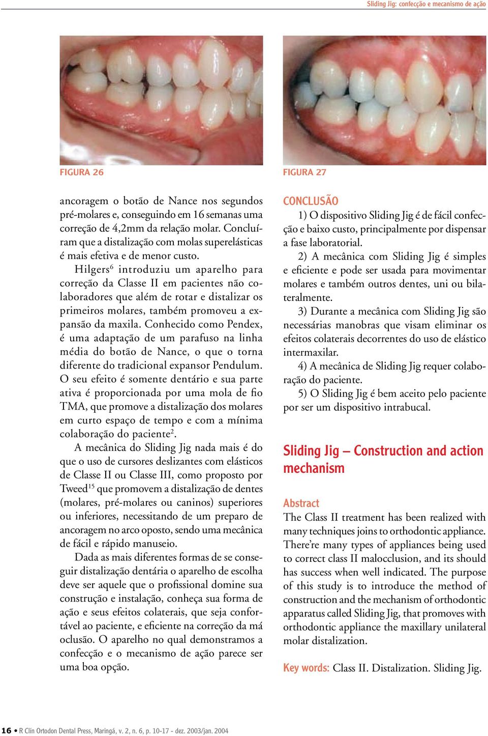 Hilgers 6 introduziu um aparelho para correção da Classe II em pacientes não colaboradores que além de rotar e distalizar os primeiros molares, também promoveu a expansão da maxila.