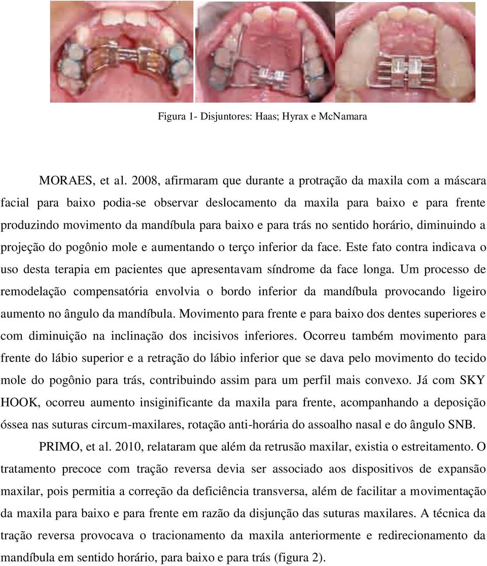 trás no sentido horário, diminuindo a projeção do pogônio mole e aumentando o terço inferior da face.