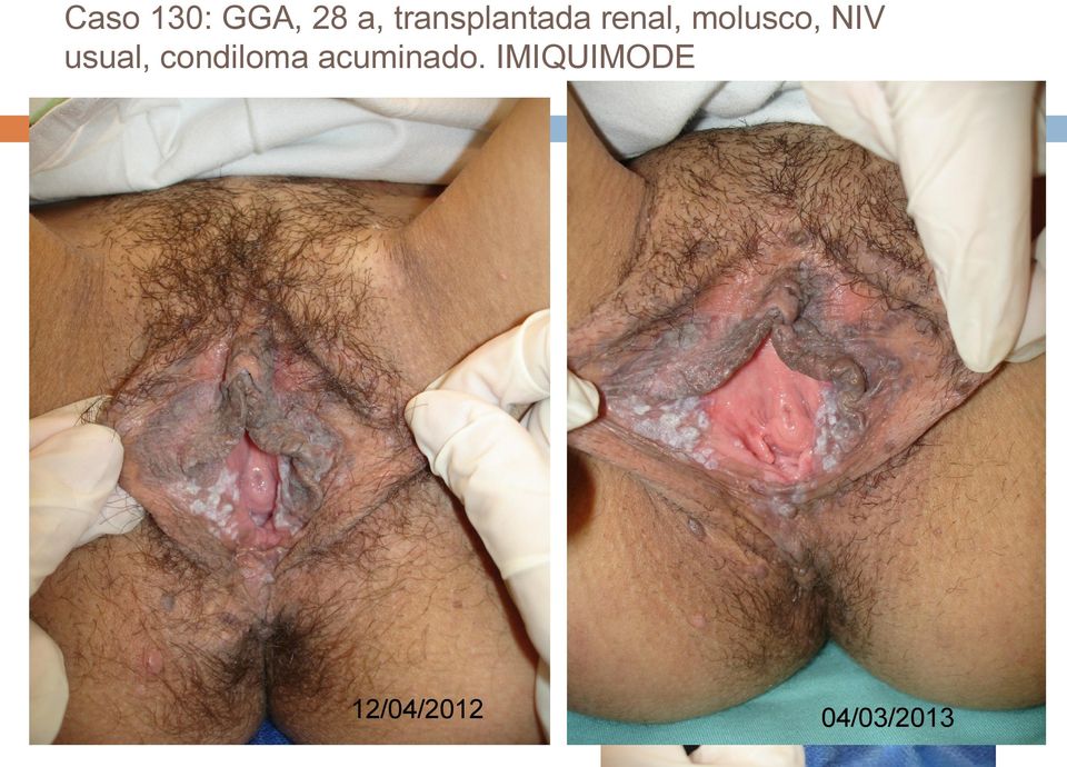 molusco, NIV usual,