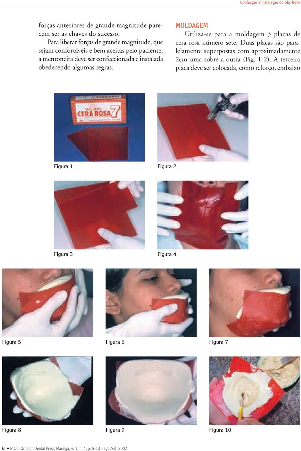 MOLDAGEM Utiliza-se para a moldagem 3 placas de cera rosa número sete. Duas placas são paralelamente superpostas com aproximadamente 2cm uma sobre a outra (Fig. 1-2).