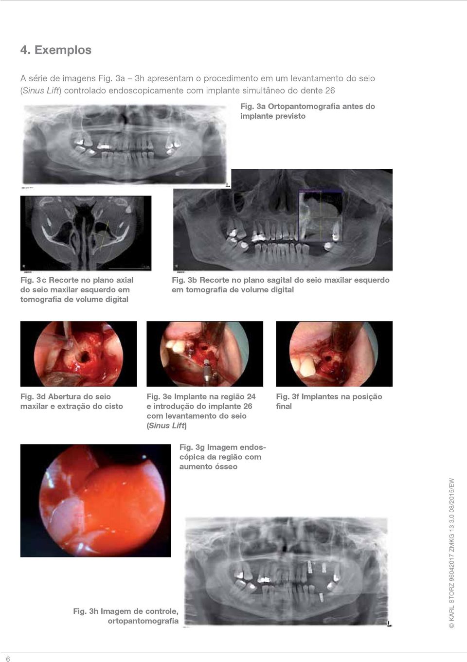 3a Ortopantomografia antes do implante previsto Fig. 3 c Recorte no plano axial do seio maxilar esquerdo em tomografia de volume digital Fig.