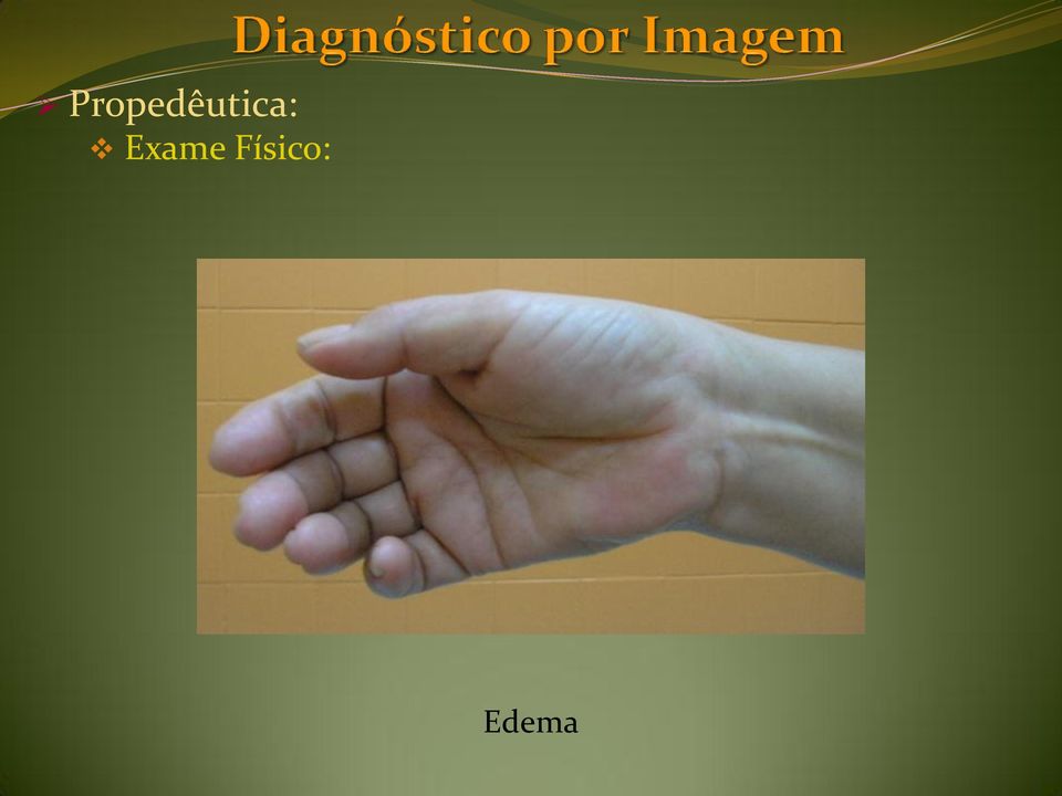 Edema