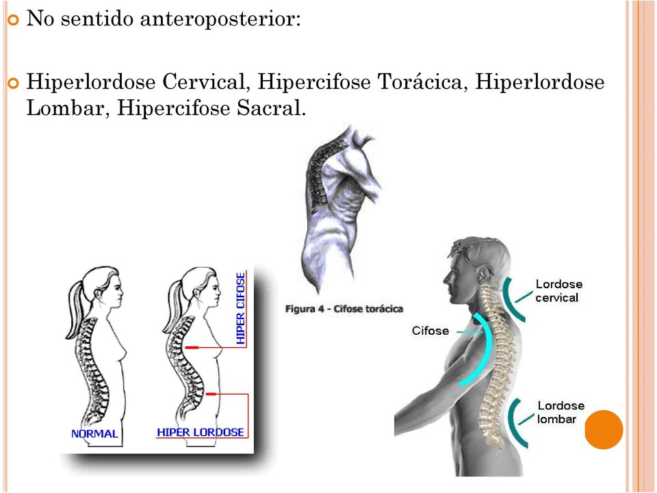 Hipercifose Torácica,