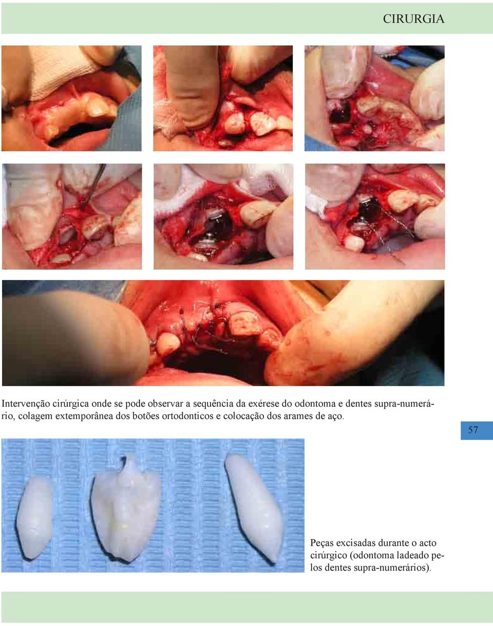 botões ortodonticos e colocação dos arames de aço.