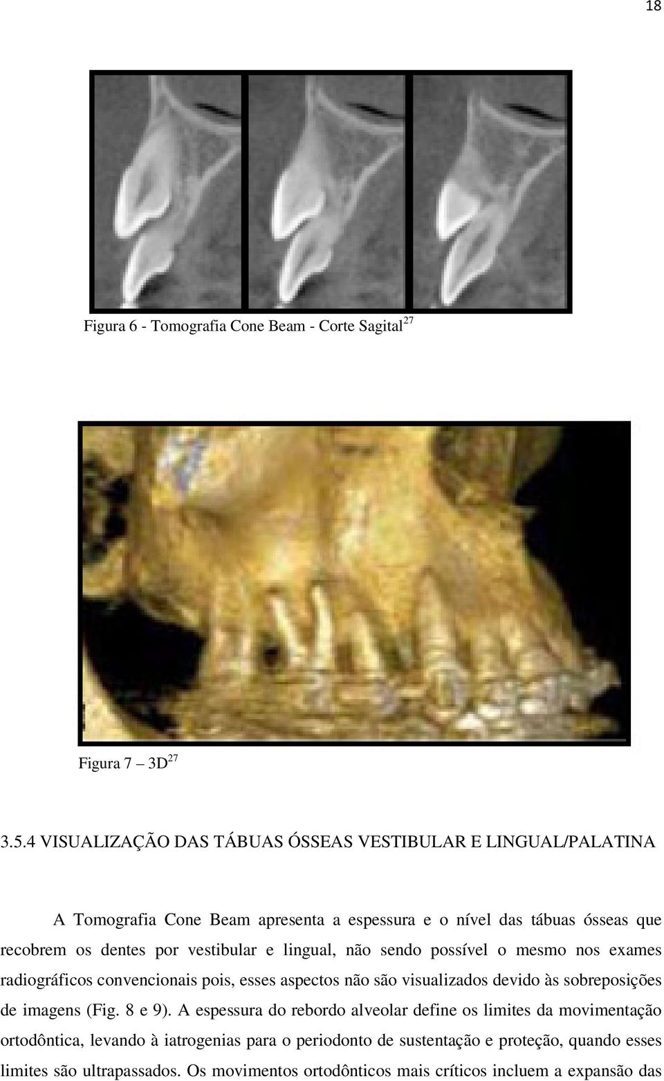 vestibular e lingual, não sendo possível o mesmo nos exames radiográficos convencionais pois, esses aspectos não são visualizados devido às sobreposições de imagens