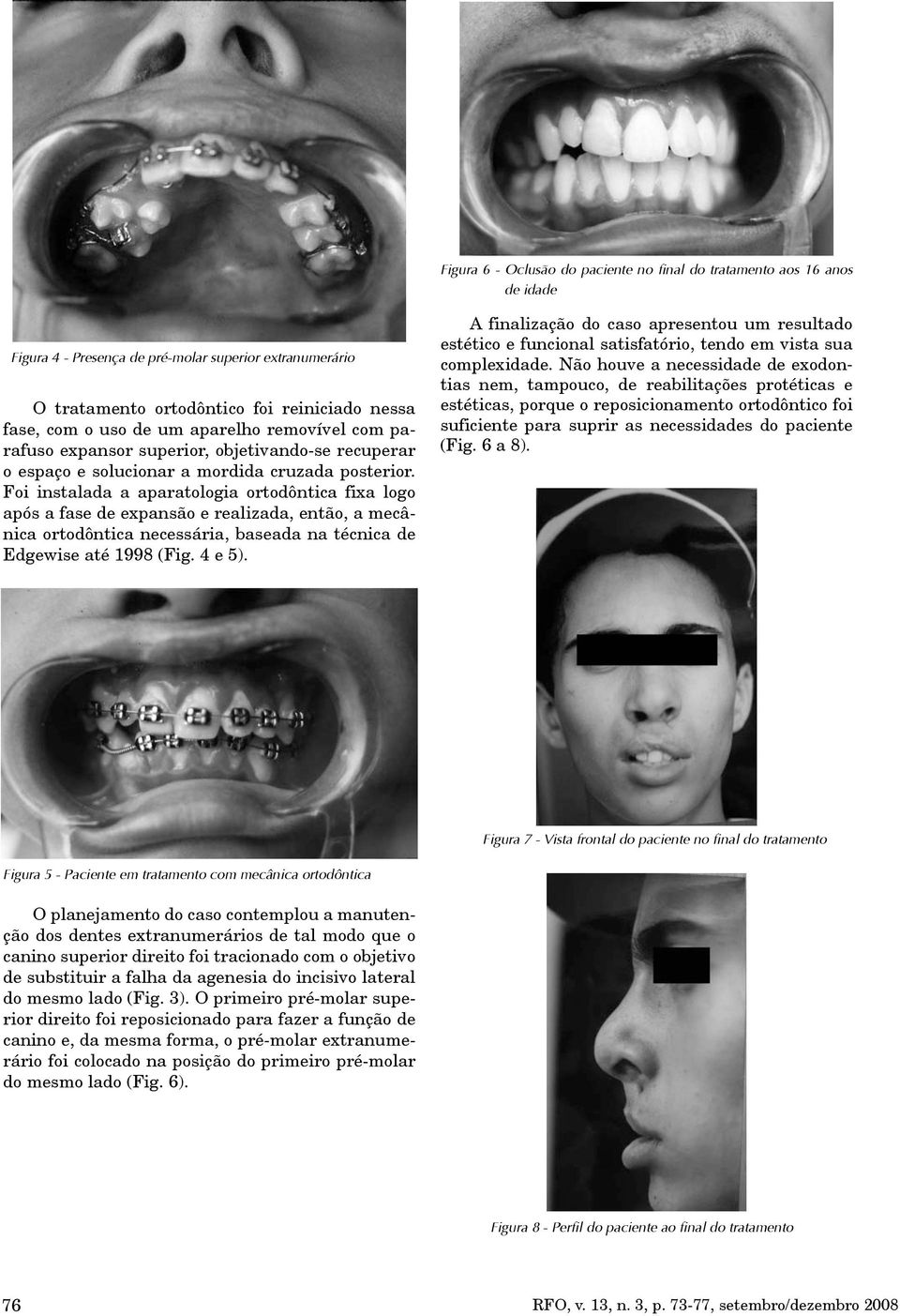 Foi instalada a aparatologia ortodôntica fixa logo após a fase de expansão e realizada, então, a mecânica ortodôntica necessária, baseada na técnica de Edgewise até 1998 (Fig. 4 e 5).