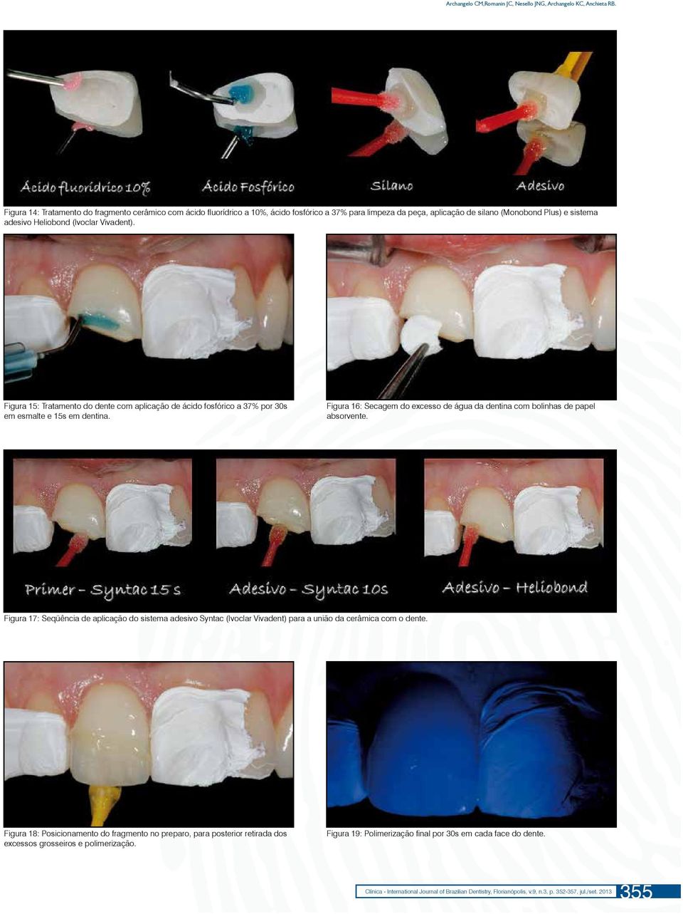 (Ivoclar Vivadent). Figura 15: Tratamento do dente com aplicação de ácido fosfórico a 37% por 30s em esmalte e 15s em dentina.