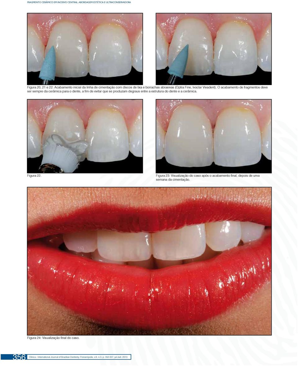 O acabamento de fragmentos deve ser sempre da cerâmica para o dente, a fim de evitar que se produzam degraus entre a estrutura