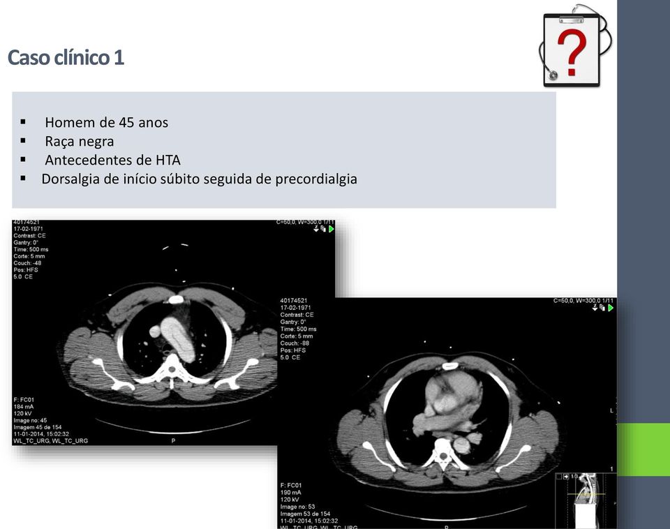 de HTA Dorsalgia de início