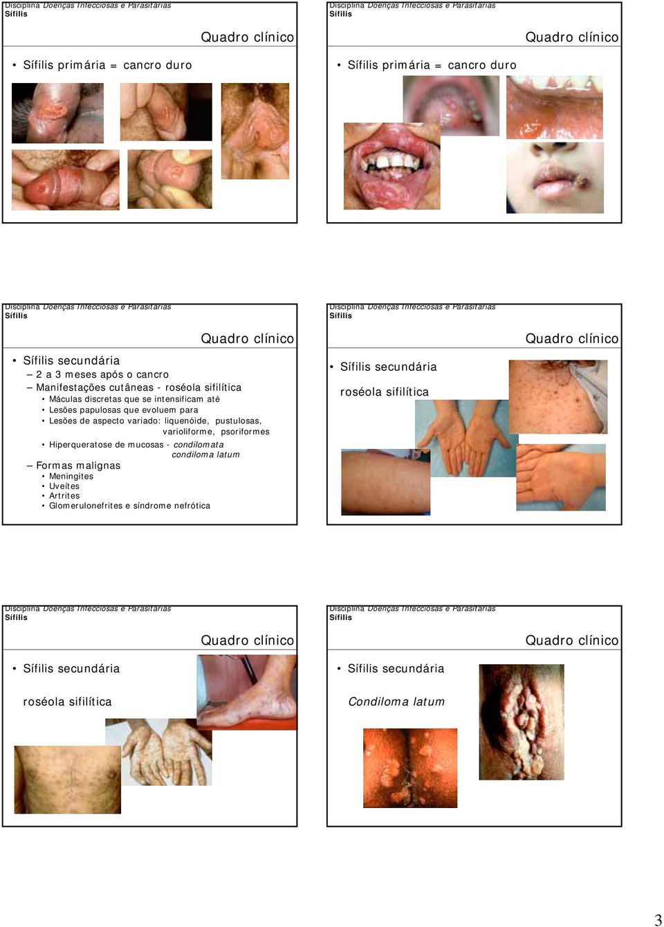 varioliforme, psoriformes Hiperqueratose de mucosas - condilomata condiloma latum Formas malignas Meningites Uveítes Artrites