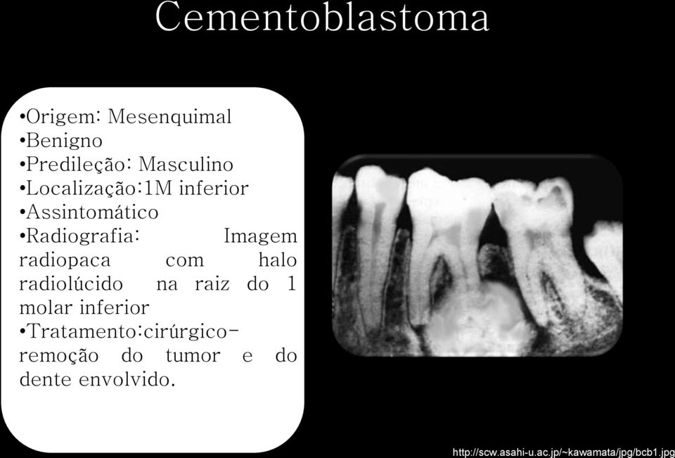 halo radiolúcido na raiz do 1 molar inferior Tratamento:cirúrgicoremoção