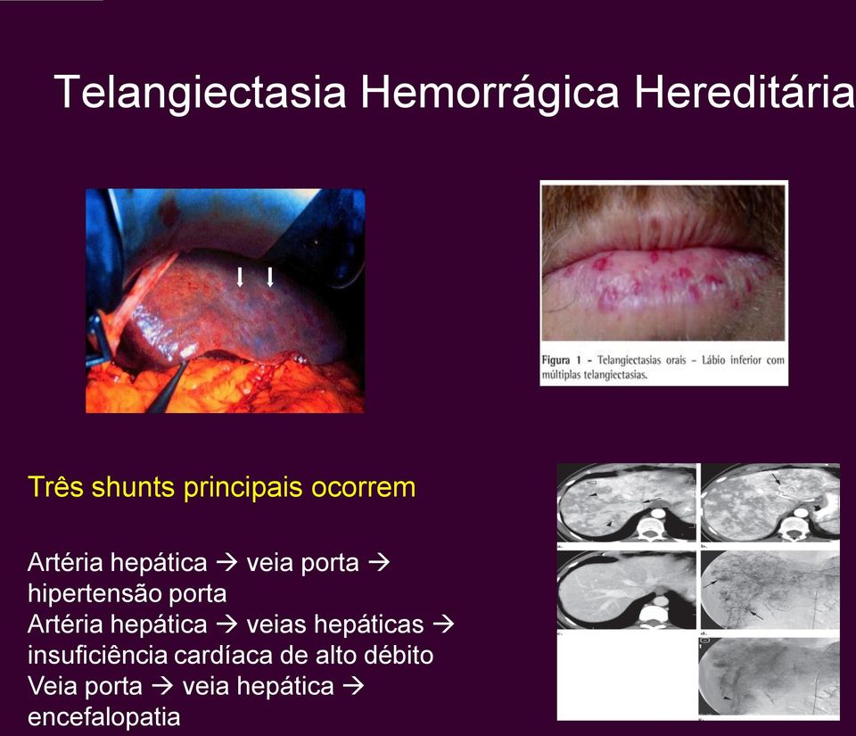 hipertensão porta Artéria hepática veias hepáticas