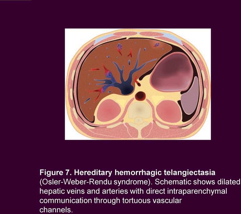 (Osler-Weber-Rendu syndrome).