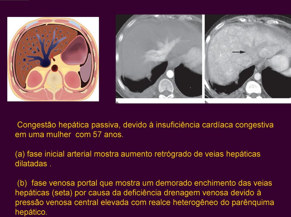 (b) fase venosa portal que mostra um demorado enchimento das veias hepáticas (seta) por causa da