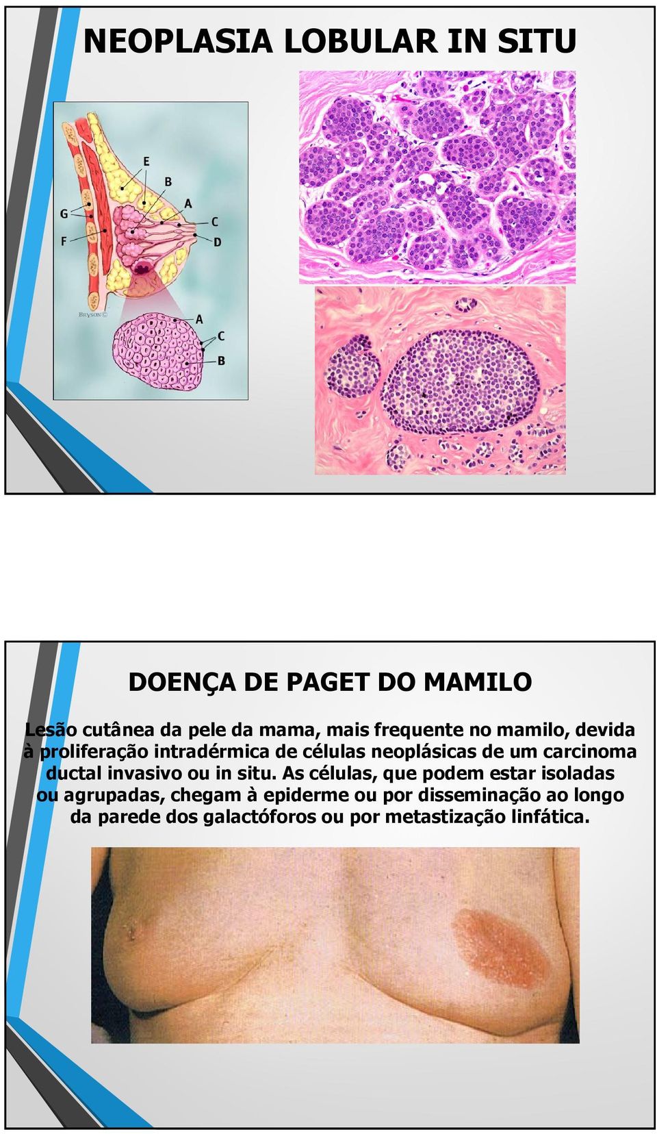 carcinoma ductal invasivo ou in situ.