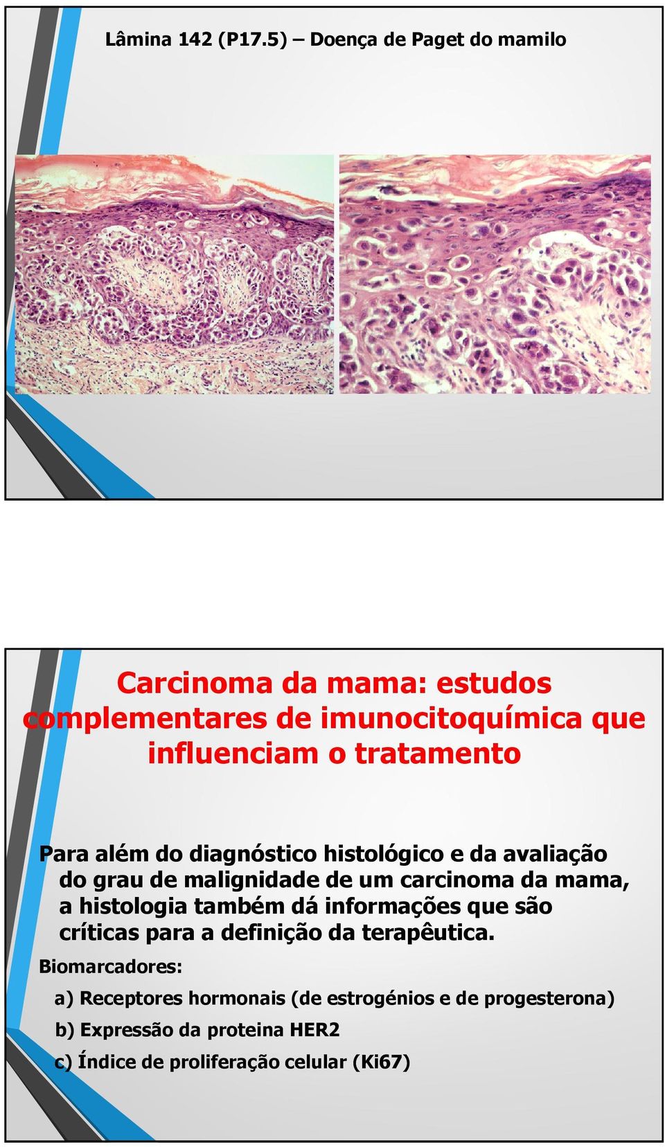 tratamento Para além do diagnóstico histológico e da avaliação do grau de malignidade de um carcinoma da mama, a