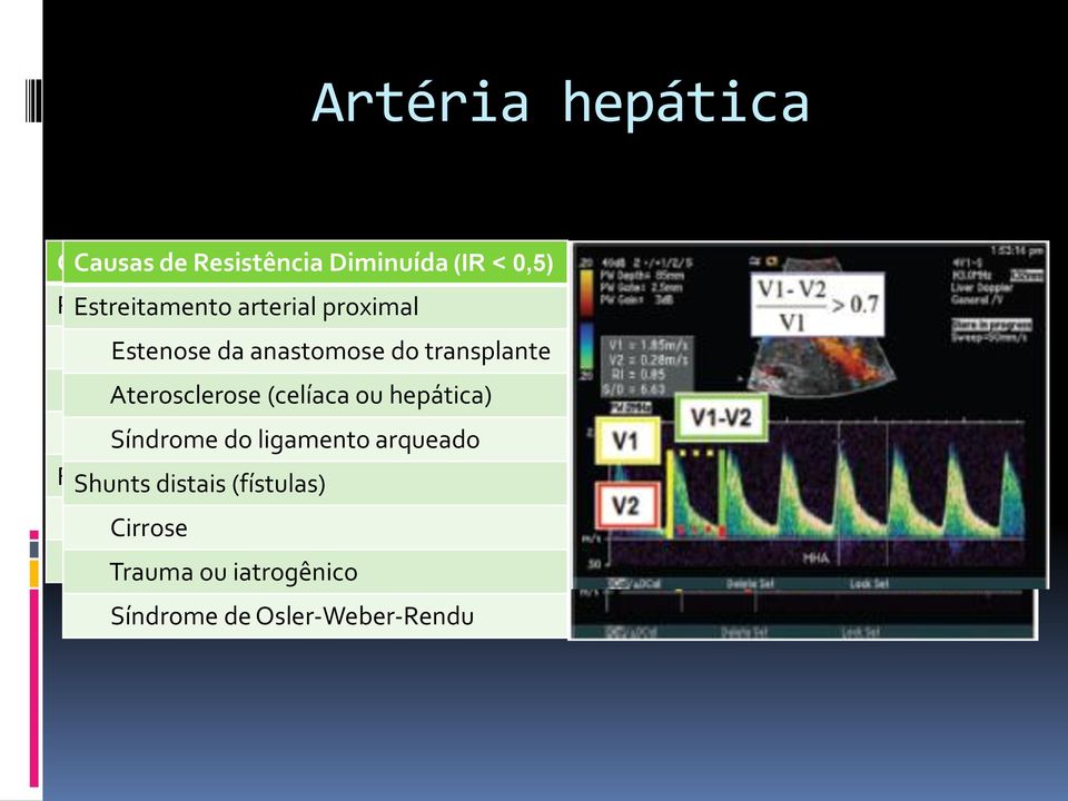 hepática (celíaca ou hepática) Rejeição Síndrome ao do transplante ligamento arqueado Fisiológica Shunts