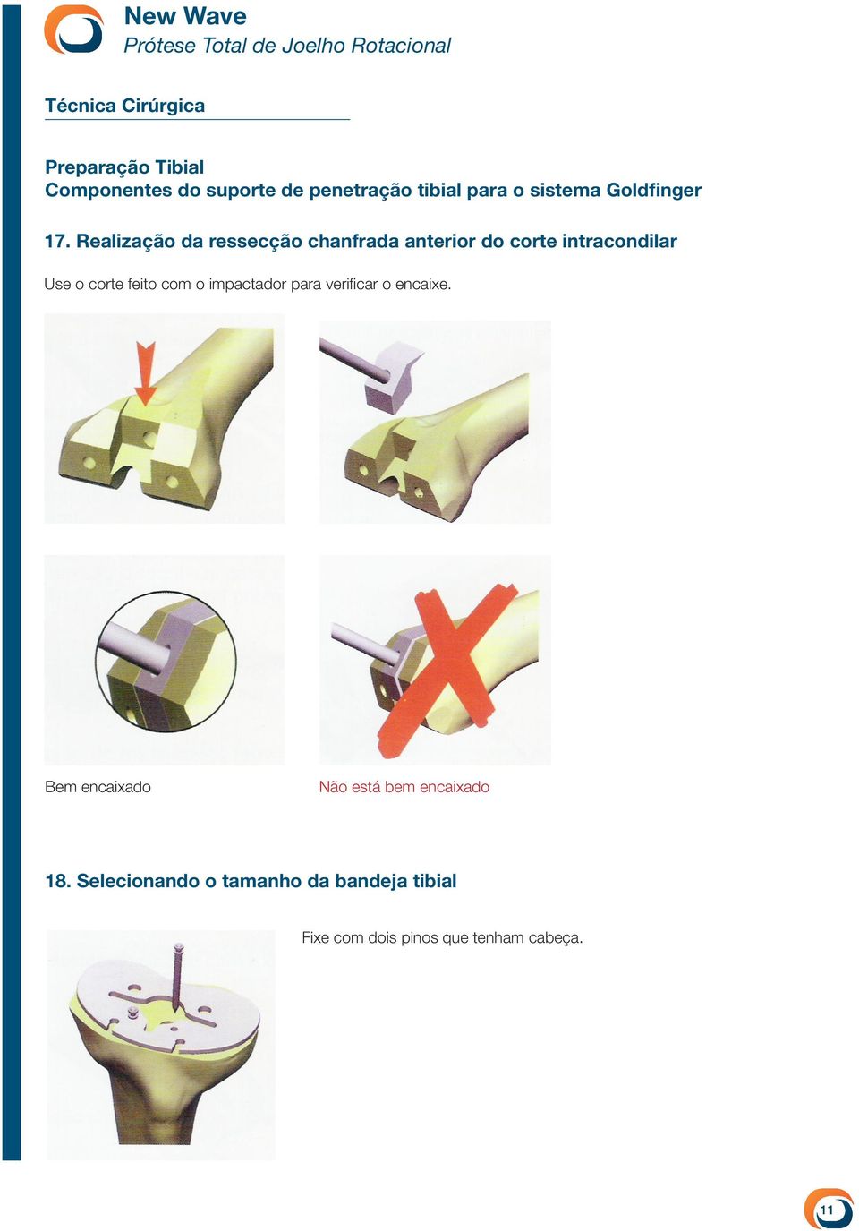 Realização da ressecção chanfrada anterior do corte intracondilar Use o corte feito