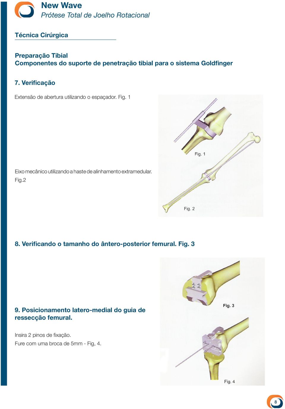 1 Eixo mecânico utilizando a haste de alinhamento extramedular. Fig.2 8.