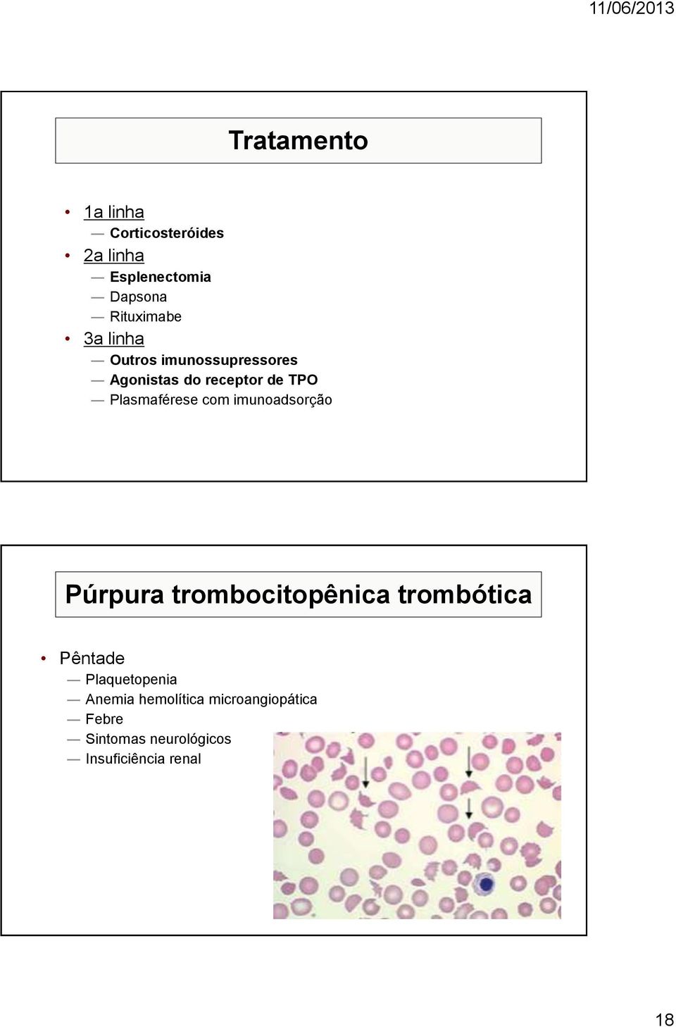 com imunoadsorção Púrpura trombocitopênica trombótica Pêntade Plaquetopenia