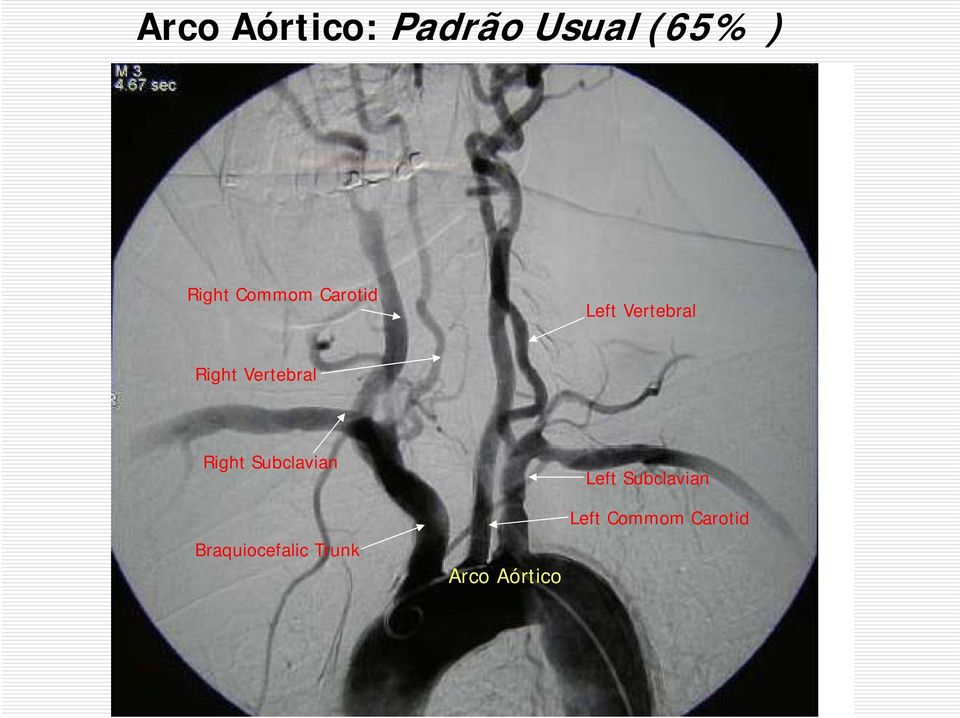 Vertebral Right Subclavian Braquiocefalic