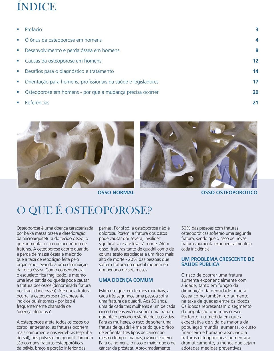 Osteoporose é uma doença caracterizada por baixa massa óssea e deterioração da microarquitetura do tecido ósseo, o que aumenta o risco de ocorrência de fraturas.