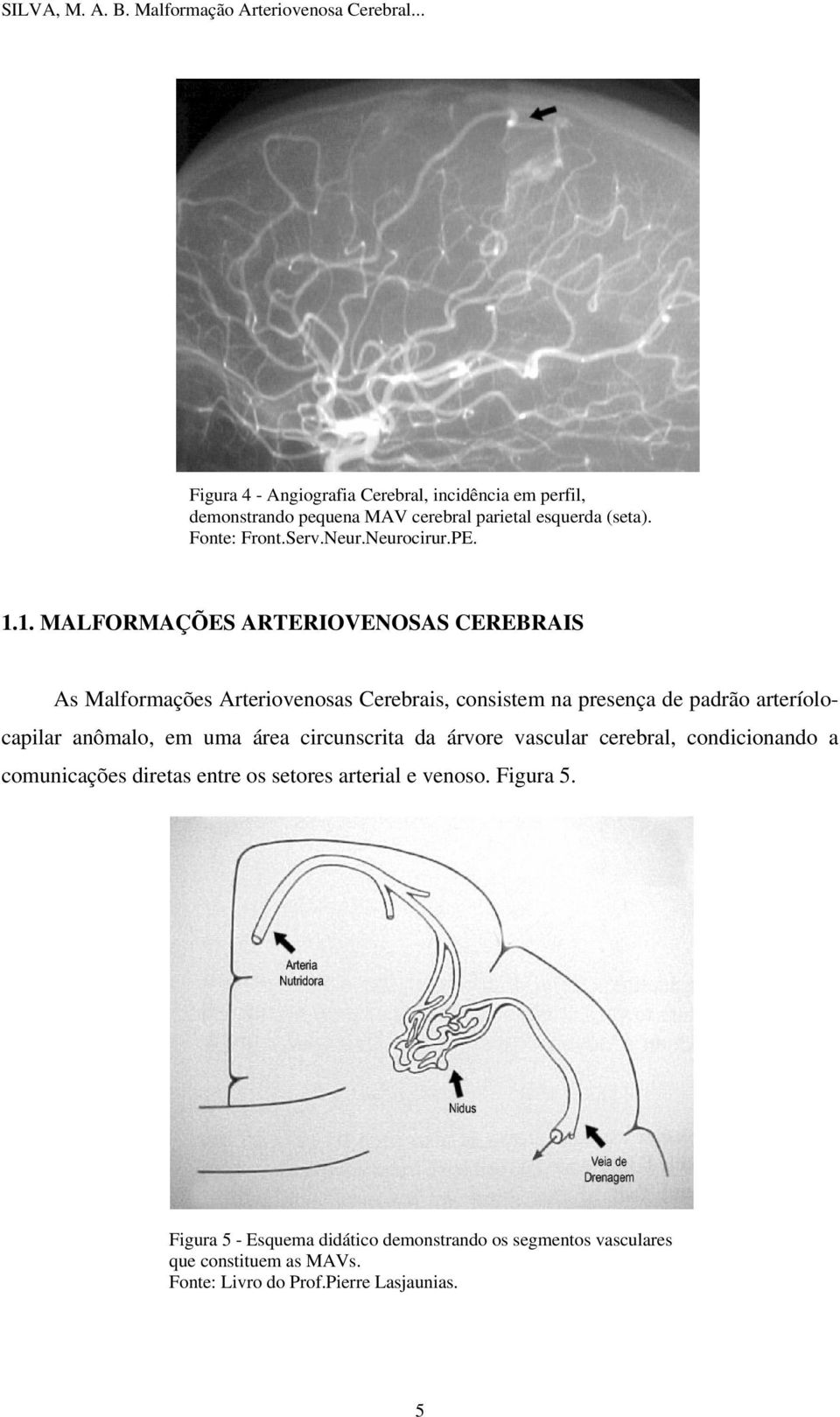 1. MALFORMAÇÕES ARTERIOVENOSAS CEREBRAIS As Malformações Arteriovenosas Cerebrais, consistem na presença de padrão arteríolocapilar anômalo,