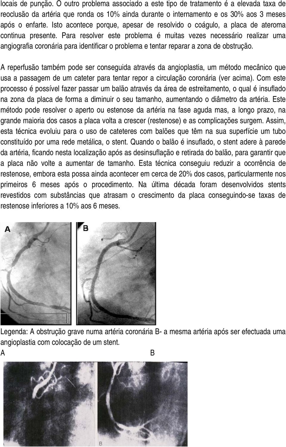 Para resolver este problema é muitas vezes necessário realizar uma angiografia coronária para identificar o problema e tentar reparar a zona de obstrução.