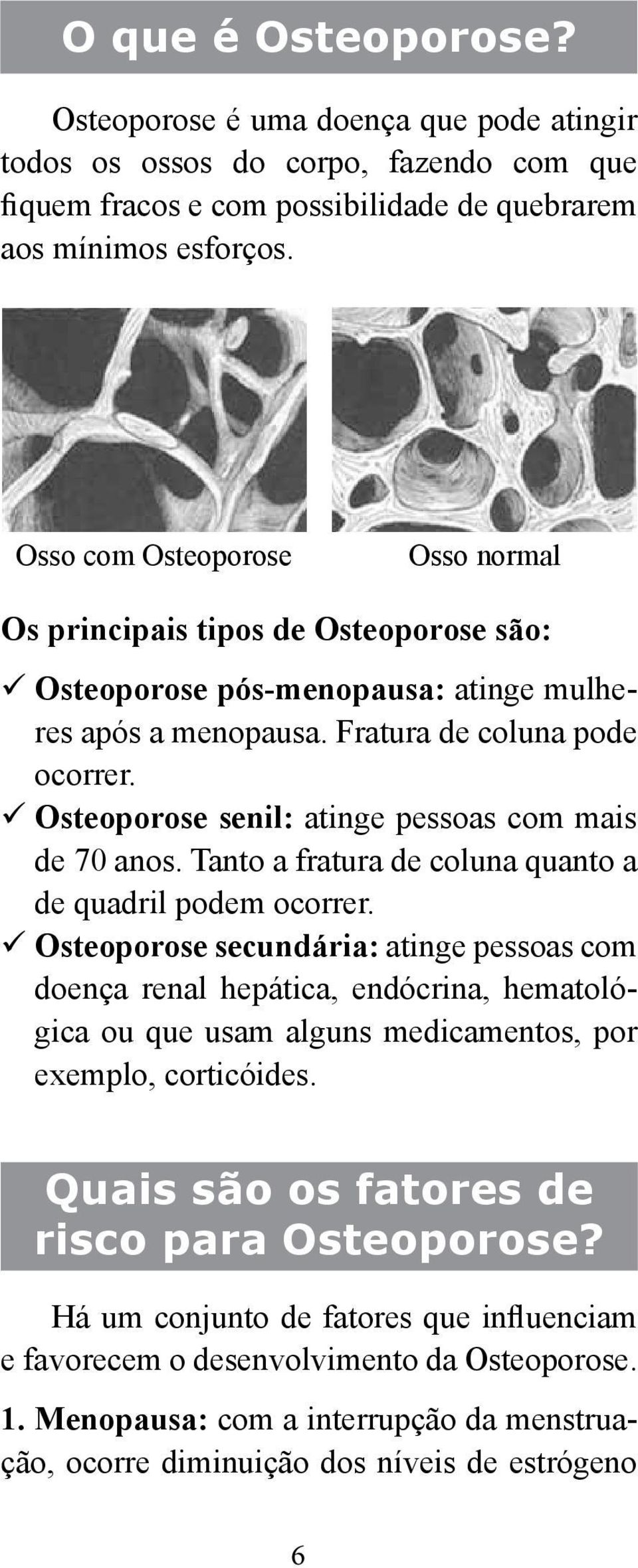 Osteoporose senil: atinge pessoas com mais de 70 anos. Tanto a fratura de coluna quanto a de quadril podem ocorrer.