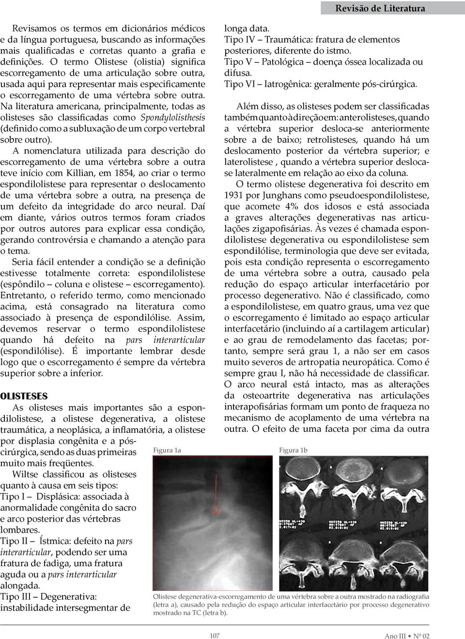 Na literatura americana, principalmente, todas as olisteses são classificadas como Spondylolisthesis (definido como a subluxação de um corpo vertebral sobre outro).