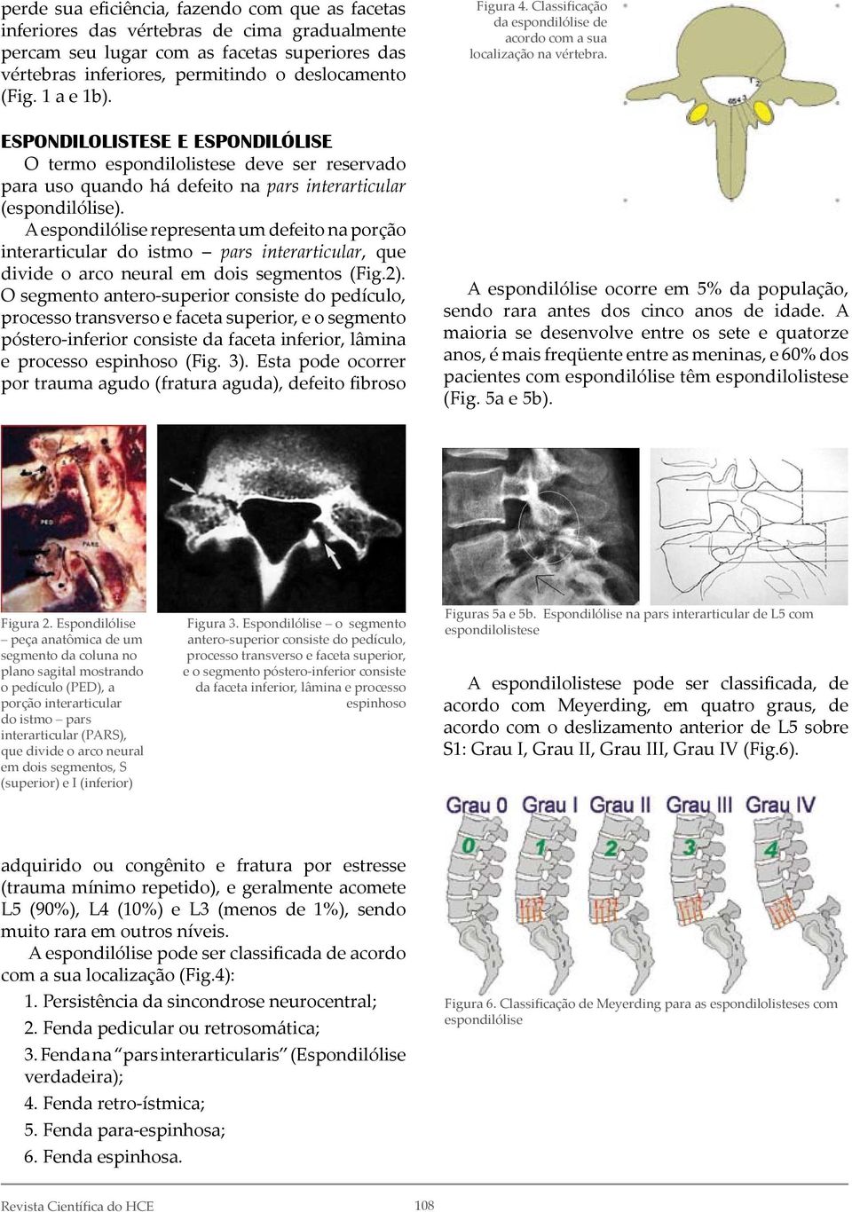 A espondilólise representa um defeito na porção interarticular do istmo pars interarticular, que divide o arco neural em dois segmentos (Fig.2).