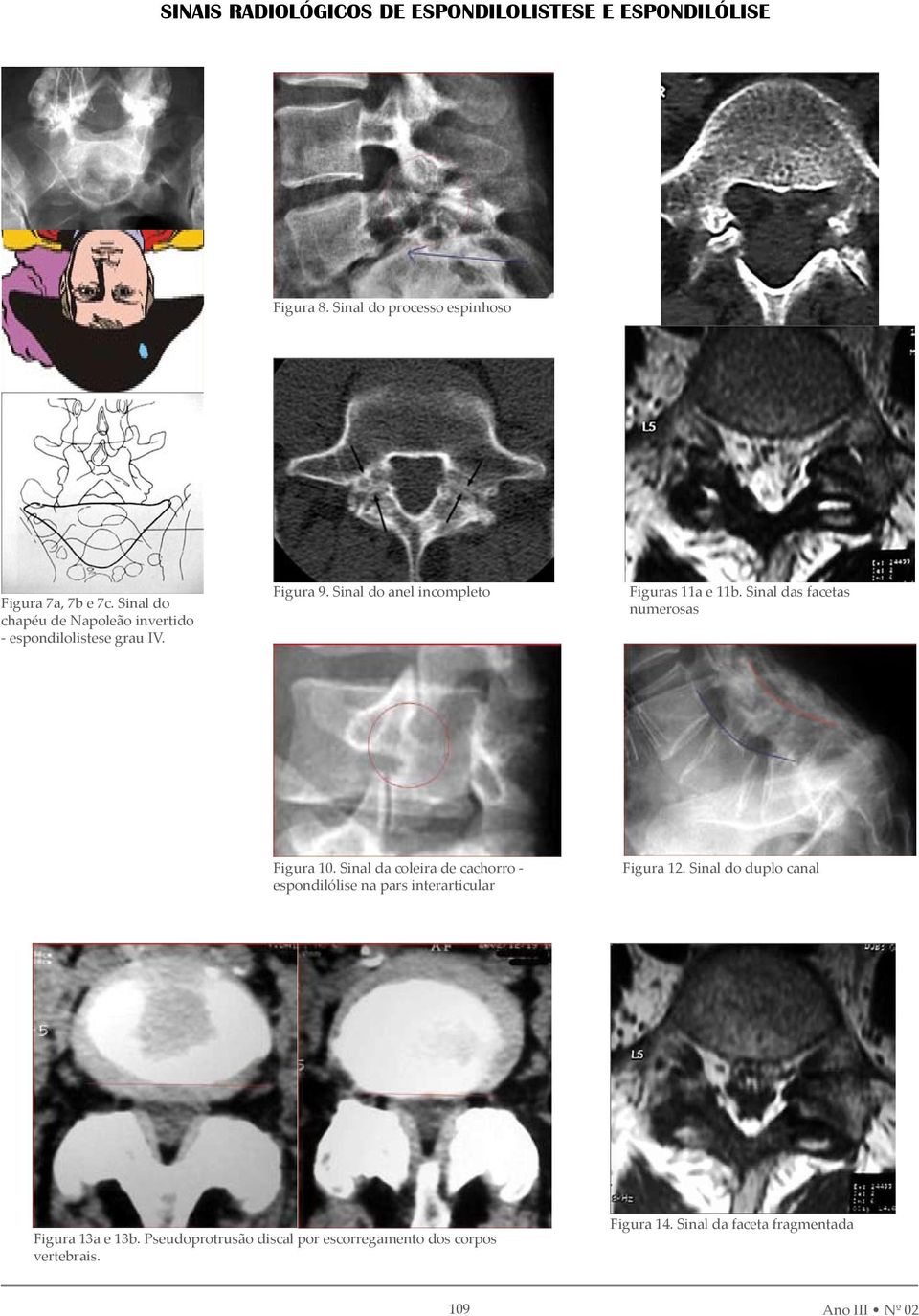 Sinal das facetas numerosas Figura 10. Sinal da coleira de cachorro - espondilólise na pars interarticular Figura 12.