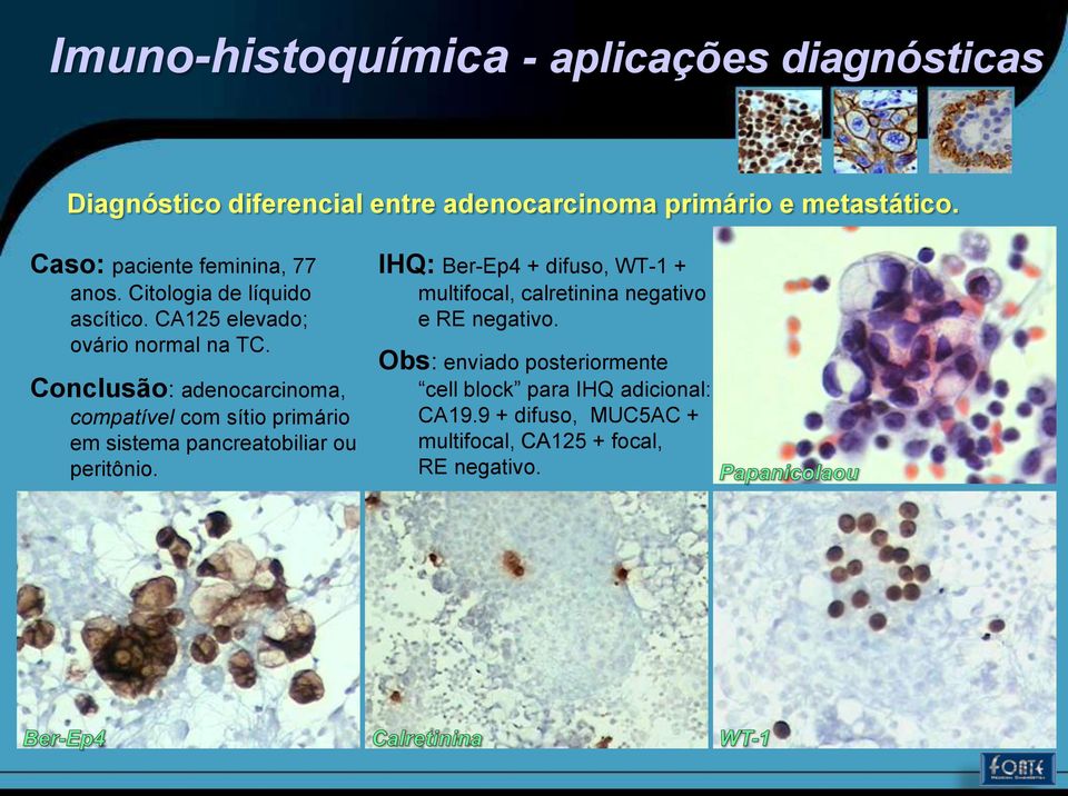 Conclusão: adenocarcinoma, compatível com sítio primário em sistema pancreatobiliar ou peritônio.