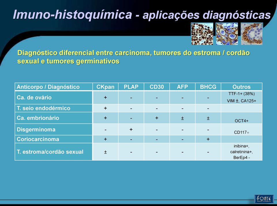 seio endodérmico + - - - - TTF-1+ (38%) VIM ±, CA125+ Ca.