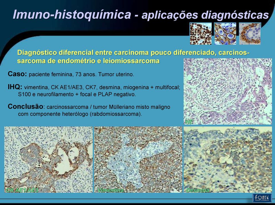 IHQ: vimentina, CK AE1/AE3, CK7, desmina, miogenina + multifocal; S100 e neurofilamento +