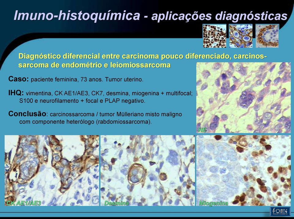 IHQ: vimentina, CK AE1/AE3, CK7, desmina, miogenina + multifocal; S100 e neurofilamento +