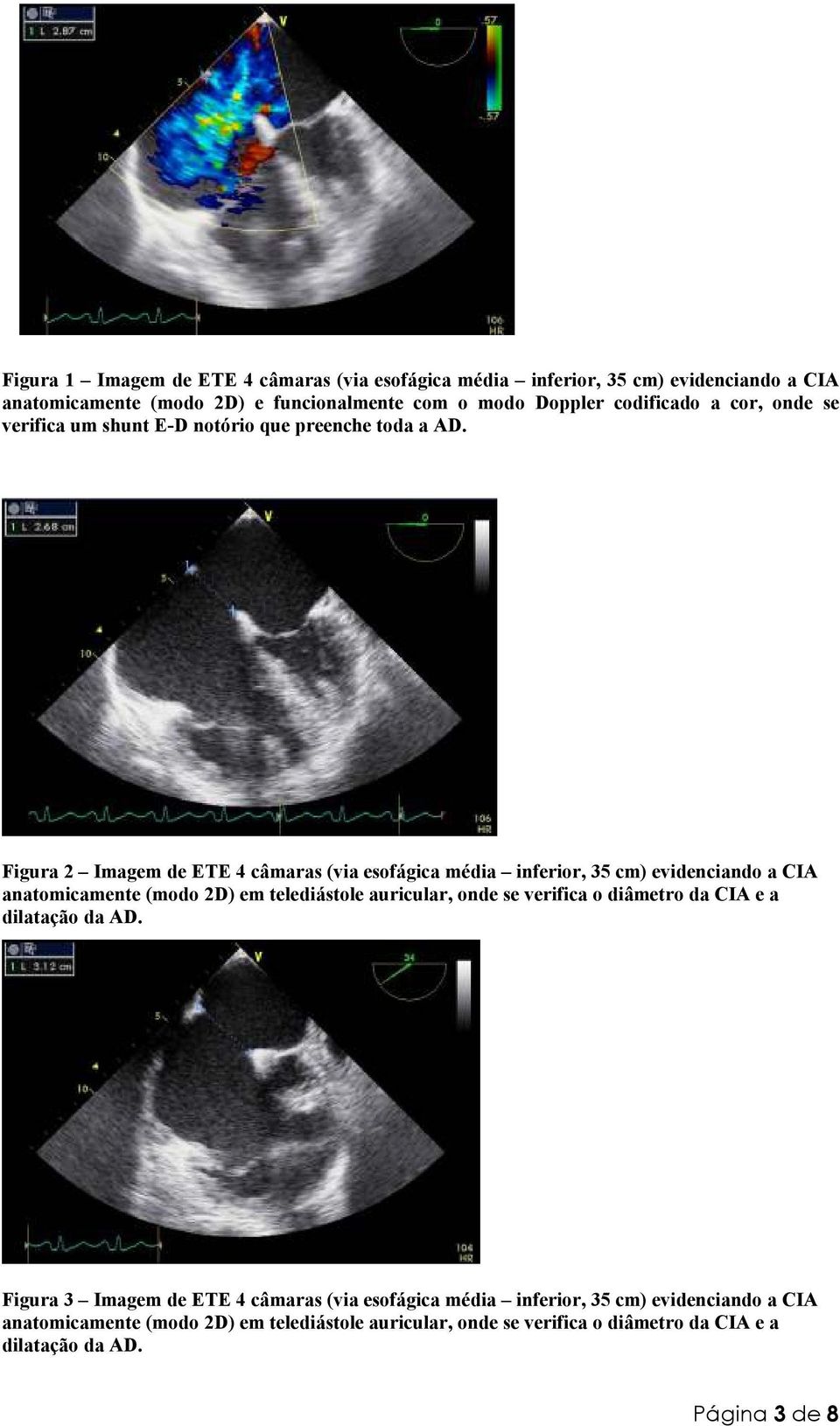 Figura 2 Imagem de ETE 4 câmaras (via esofágica média inferior, 35 cm) evidenciando a CIA anatomicamente (modo 2D) em telediástole auricular, onde se verifica