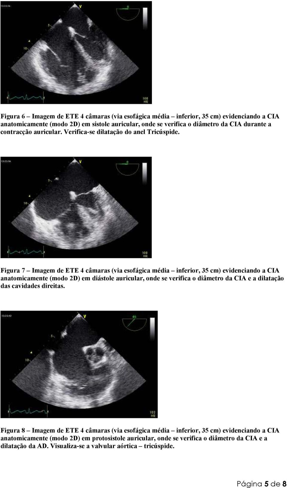 Figura 7 Imagem de ETE 4 câmaras (via esofágica média inferior, 35 cm) evidenciando a CIA anatomicamente (modo 2D) em diástole auricular, onde se verifica o diâmetro da CIA e a