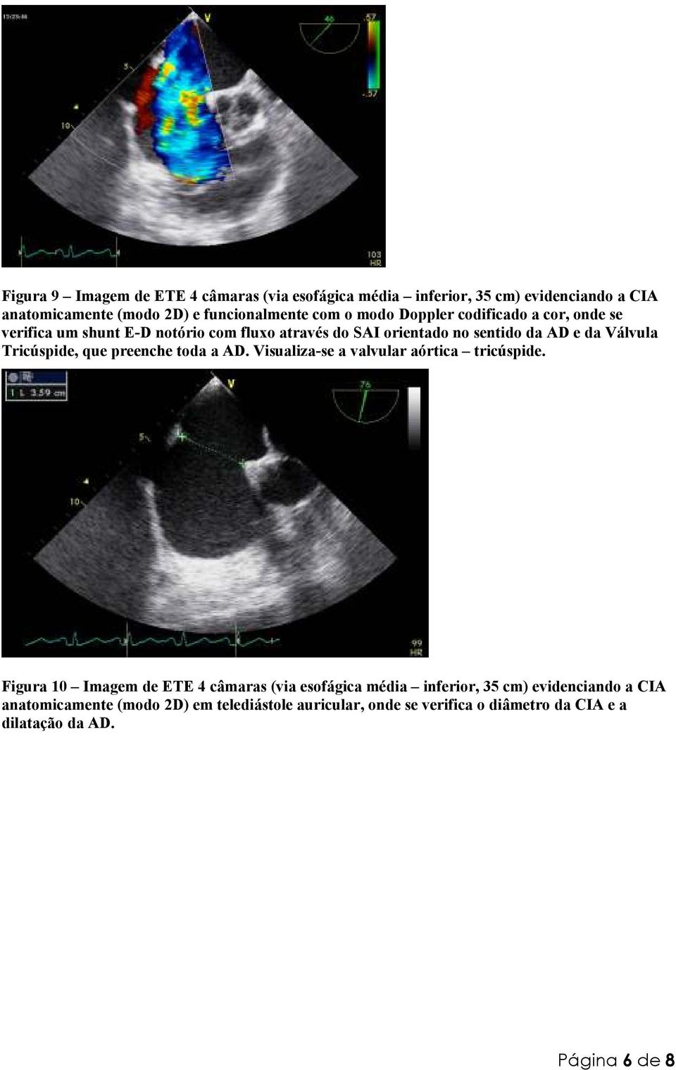 Tricúspide, que preenche toda a AD. Visualiza-se a valvular aórtica tricúspide.