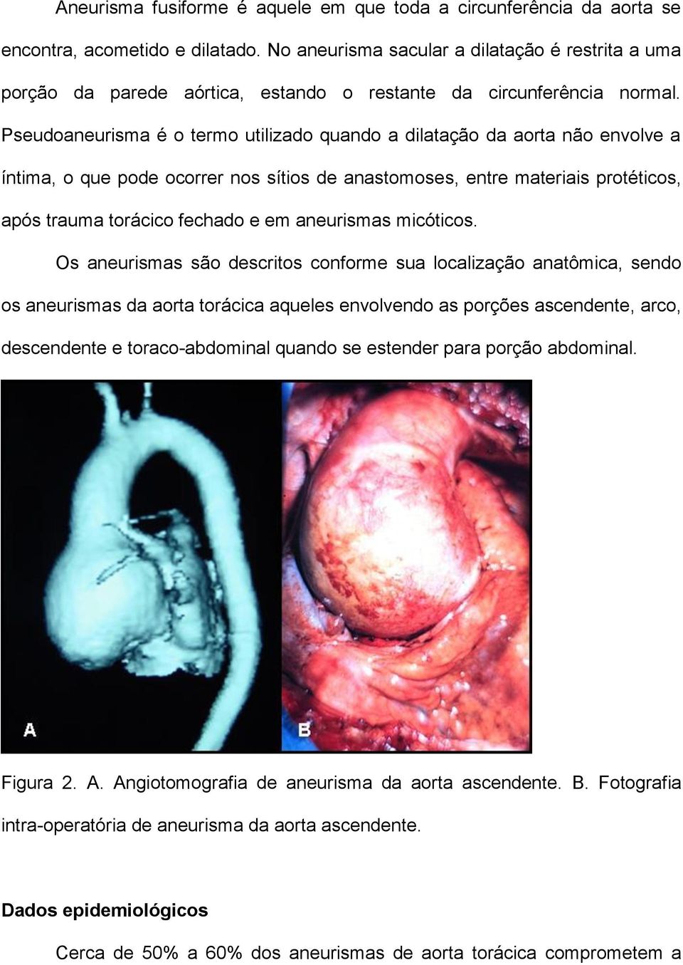 Pseudoaneurisma é o termo utilizado quando a dilatação da aorta não envolve a íntima, o que pode ocorrer nos sítios de anastomoses, entre materiais protéticos, após trauma torácico fechado e em