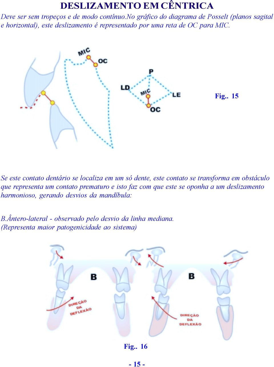 . 15 Se este contato dentário se localiza em um só dente, este contato se transforma em obstáculo que representa um contato prematuro e