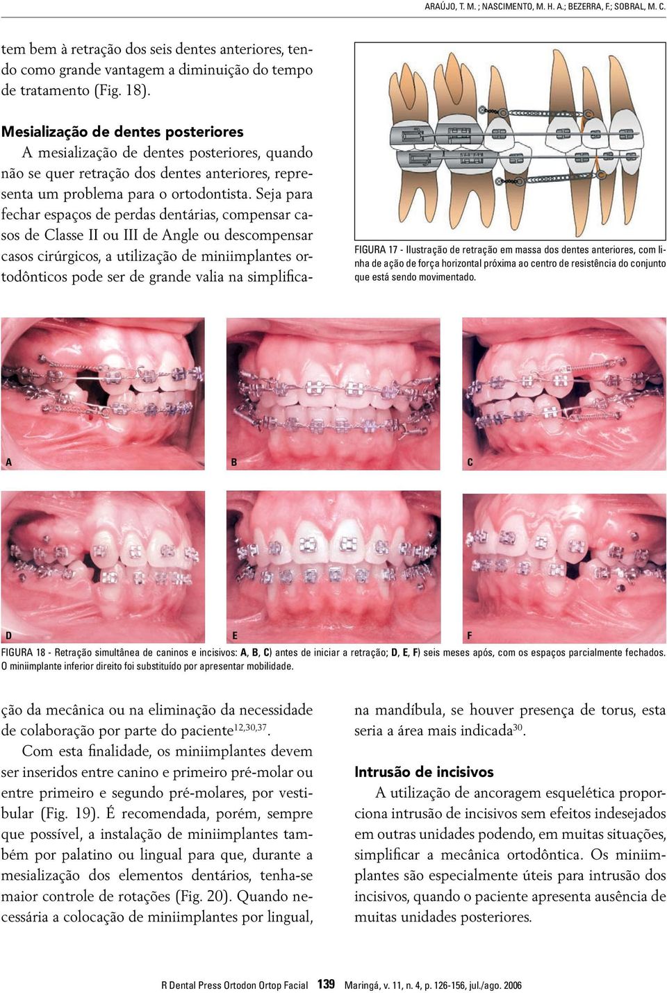 C D E FIGUR 18 - Retração simultânea de caninos e incisivos:,, C) antes de iniciar a retração; D, E, F) seis meses após, com os espaços parcialmente fechados.