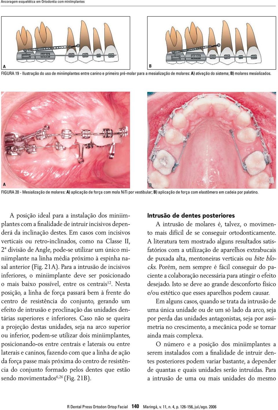 posição ideal para a instalação dos miniimplantes com a finalidade de intruir incisivos dependerá da inclinação destes.