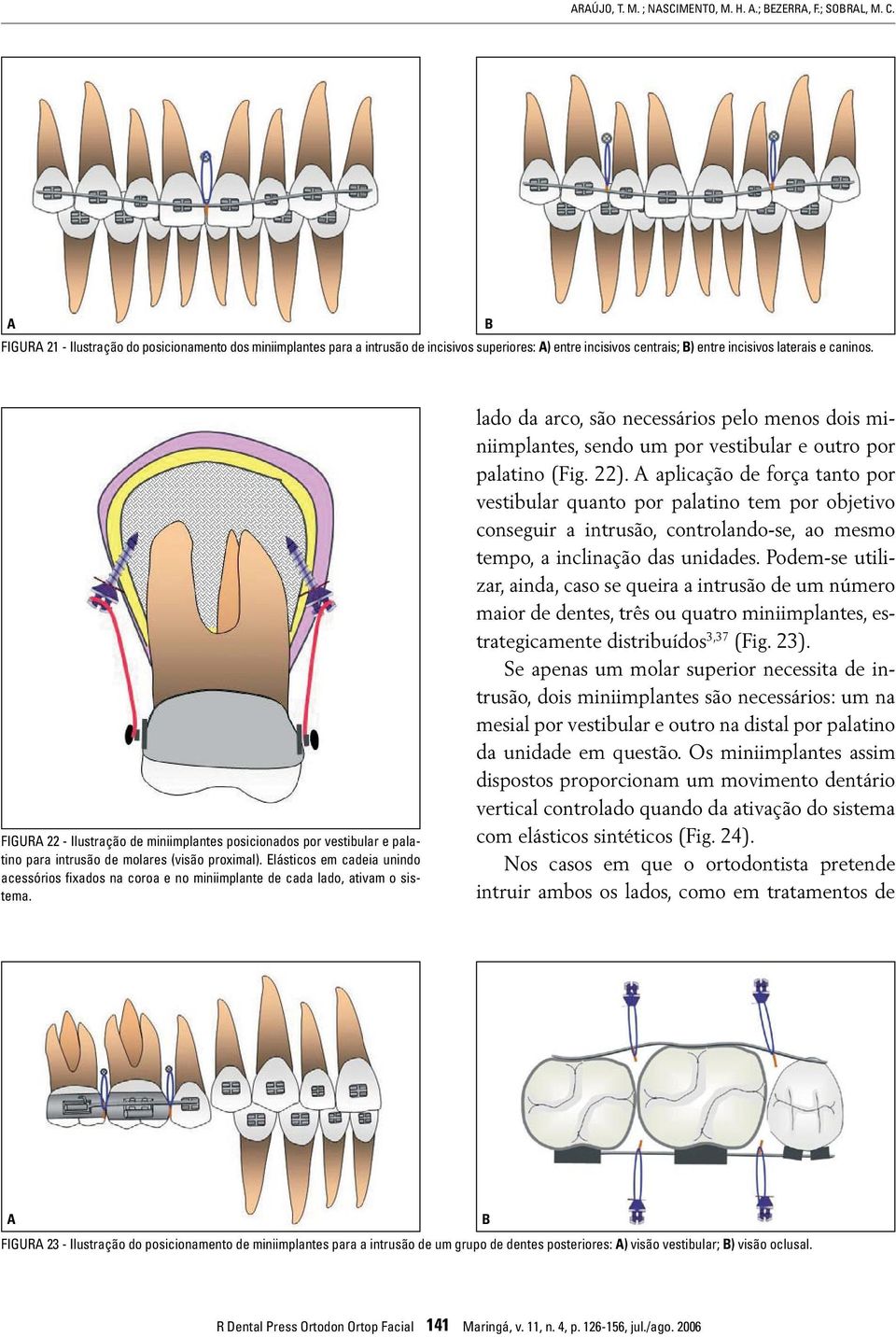 FIGUR 22 - Ilustração de miniimplantes posicionados por vestibular e palatino para intrusão de molares (visão proximal).