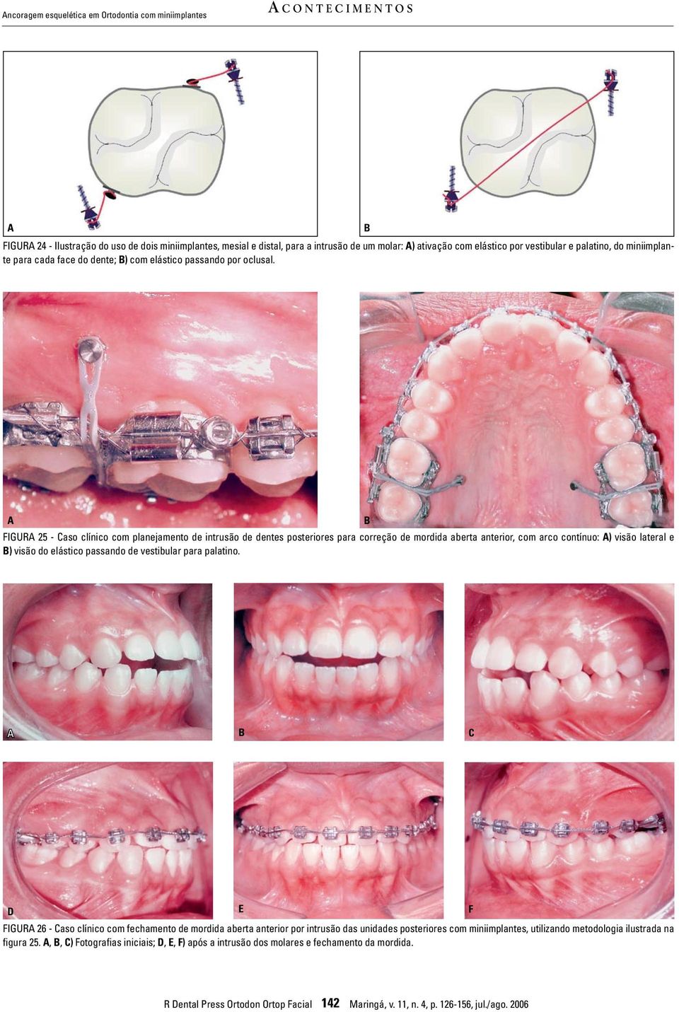 FIGUR 25 - Caso clínico com planejamento de intrusão de dentes posteriores para correção de mordida aberta anterior, com arco contínuo: ) visão lateral e ) visão do elástico passando de vestibular