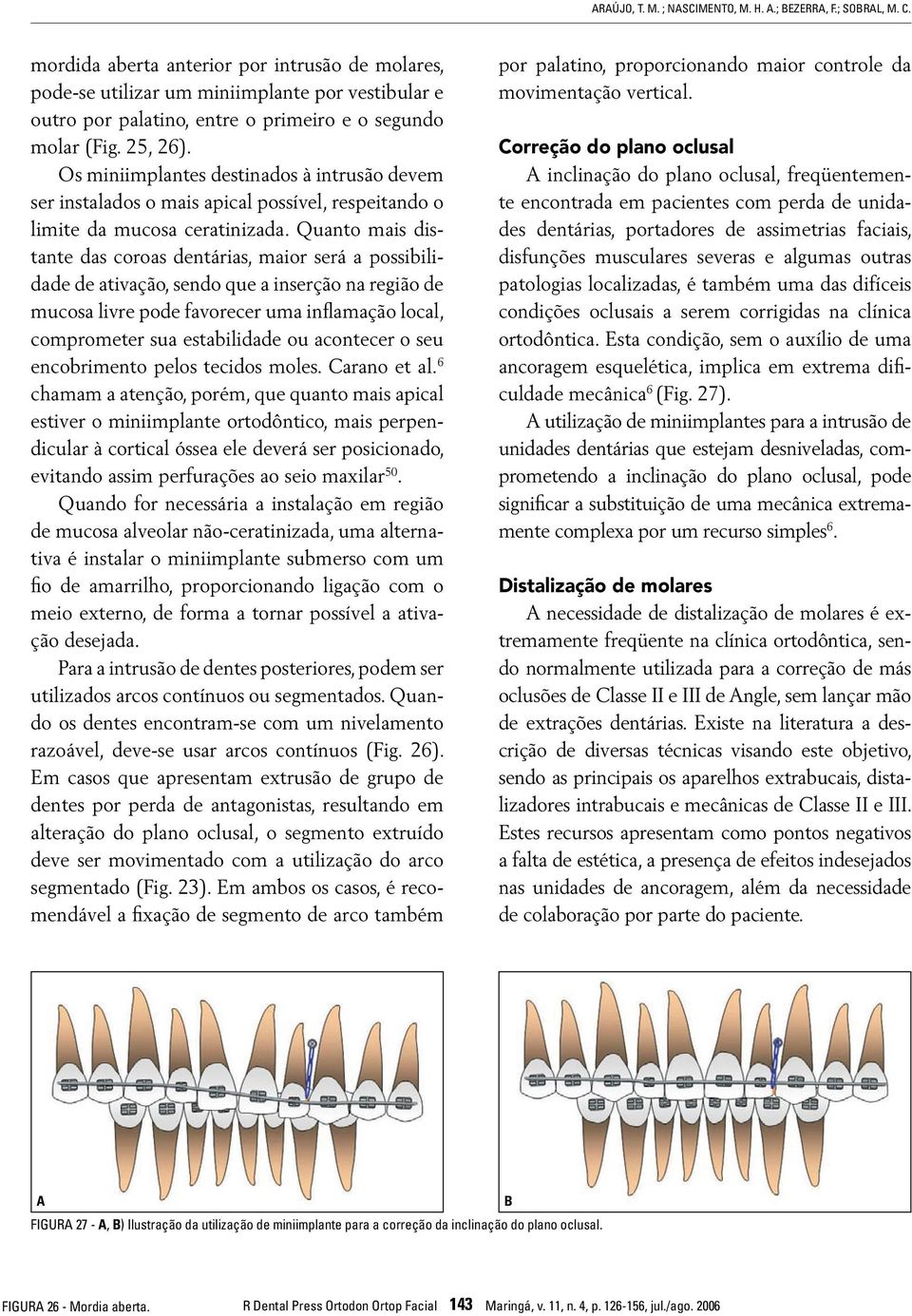 Os miniimplantes destinados à intrusão devem ser instalados o mais apical possível, respeitando o limite da mucosa ceratinizada.