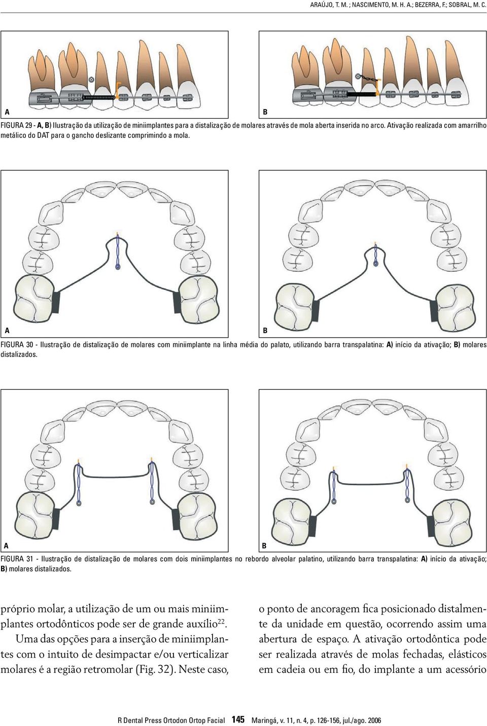 FIGUR 30 - Ilustração de distalização de molares com miniimplante na linha média do palato, utilizando barra transpalatina: ) início da ativação; ) molares distalizados.