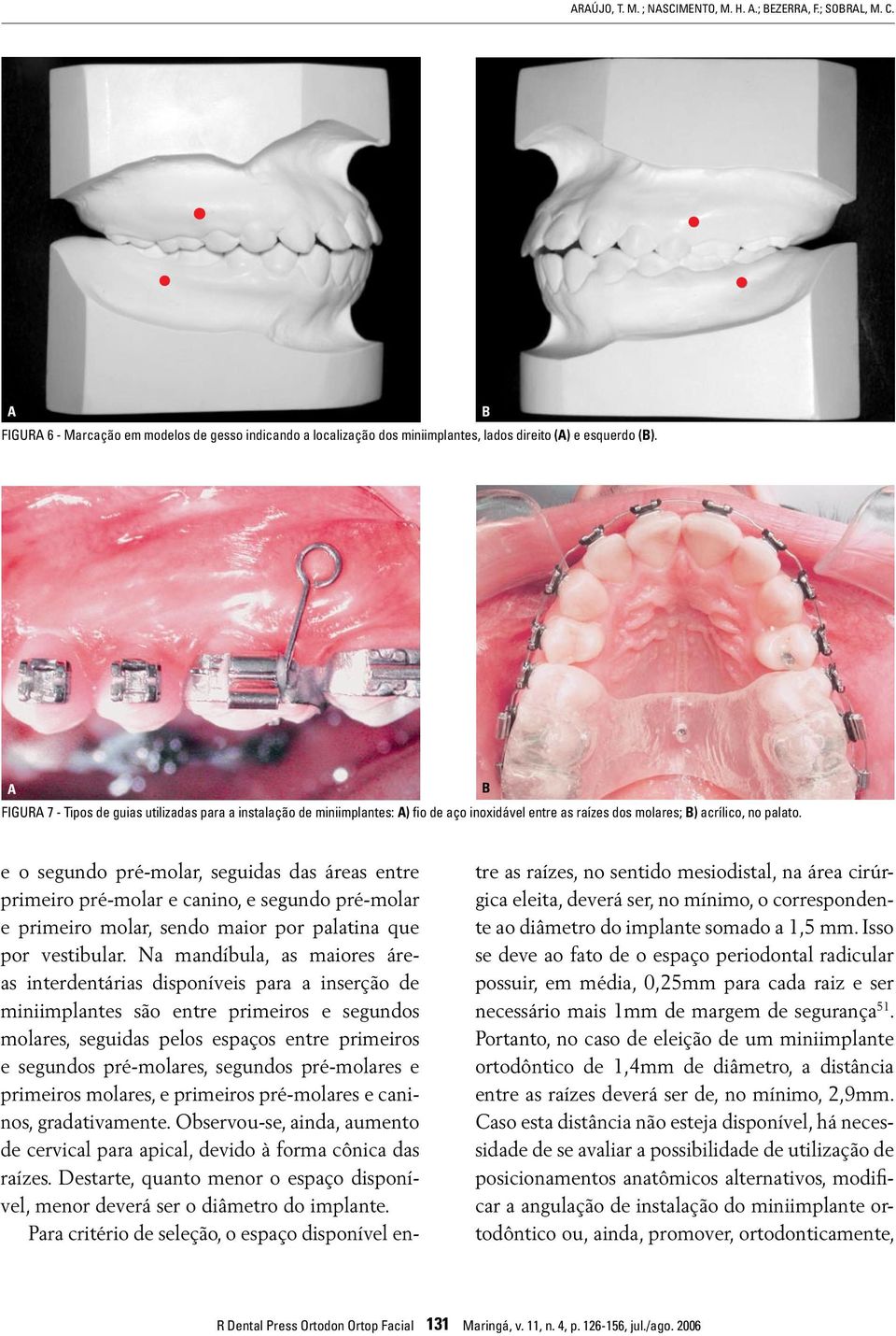 e o segundo pré-molar, seguidas das áreas entre primeiro pré-molar e canino, e segundo pré-molar e primeiro molar, sendo maior por palatina que por vestibular.