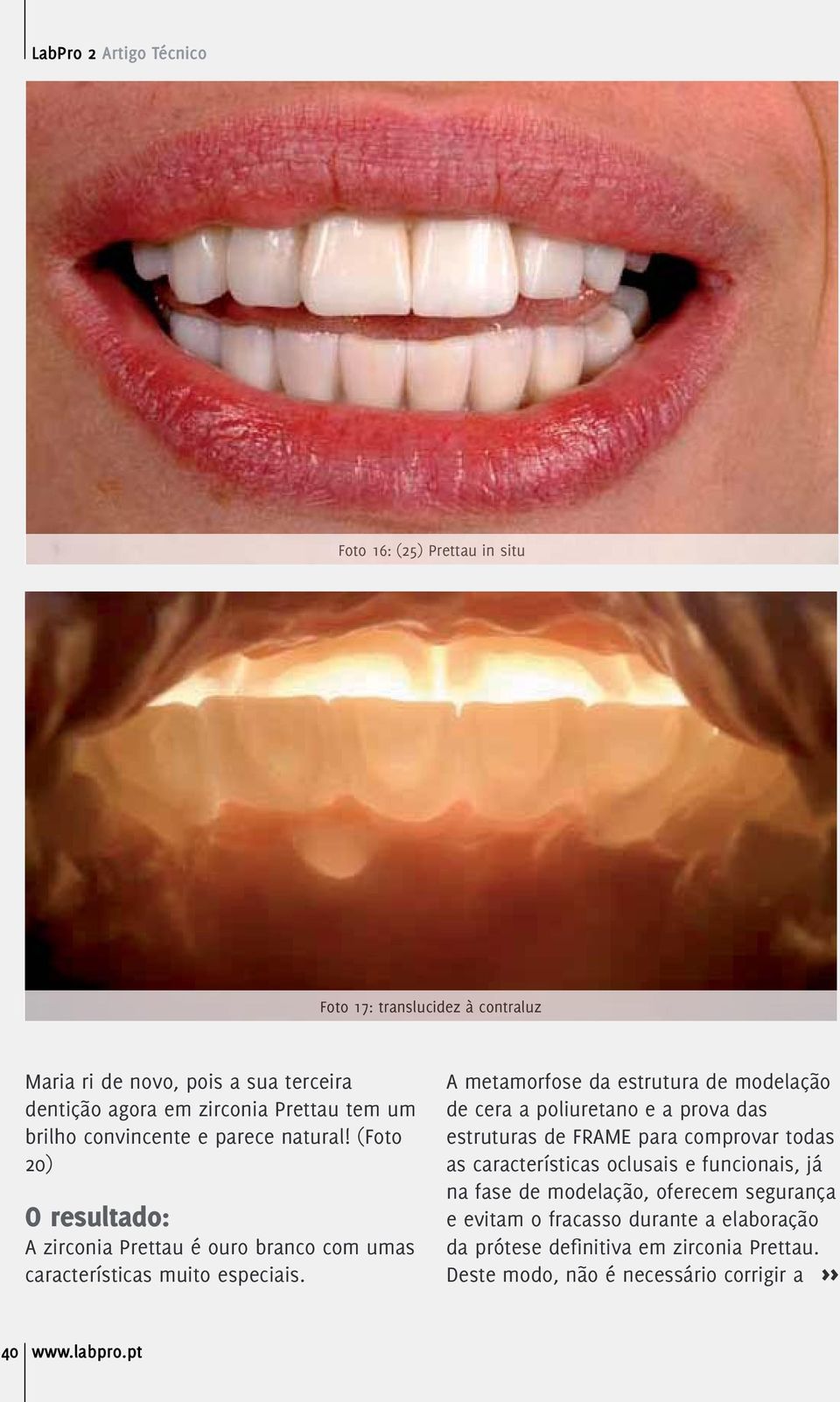 A metamorfose da estrutura de modelação de cera a poliuretano e a prova das estruturas de FRAME para comprovar todas as características oclusais e funcionais,