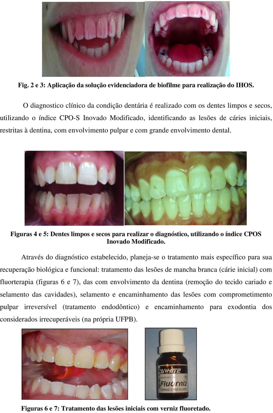 envolvimento pulpar e com grande envolvimento dental. Figuras 4 e 5: Dentes limpos e secos para realizar o diagnóstico, utilizando o índice CPOS Inovado Modificado.